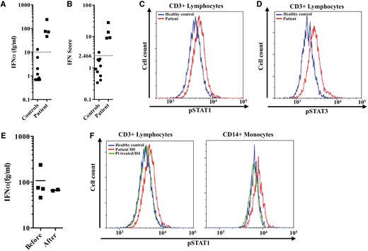 Constitutive activation of the type I interferon pathway and the ex vivo effect of ruxolitinib on constitutive phosphorylation of STAT1. (A) IFNα protein concentration (healthy controls <10 fg/ml) measured in the serum from the patient before treatment with ruxolitinib. (B) IFN score (normal <2.466) of the patient before treatment with ruxolitinib reflecting increased expression of IFN-induced gene transcripts. (C and D) Increased constitutive phosphorylation of STAT1 (C) and STAT3 (D) in CD3+ lymphocytes from the patient compared to a healthy control. (E) IFNα protein concentration (healthy controls <10 fg/ml) measured in the serum from the patient before and during treatment with ruxolitinib. Black lines depict median values. (F) Peripheral blood mononuclear cells (PBMCs) were obtained from the patient before treatment and 4 h after the first ruxolitinib intake. The treatment is taken twice daily. STAT1 constitutive phosphorylation in CD3+ lymphocytes and monocytes was decreased after treatment, being comparable to a healthy control.