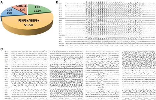 Clinical spectrum associated with HCN1 variants and examples of EEG recordings in HCN1 patients. (A) Graphic representation of the phenotypic spectrum associated with HCN1 variants. (B) EEG recorded in Patient 19 the HCN1 p.Arg590Gln variant, showing typical, generalized 3 Hz spike wave discharges lasting 10 s recorded while the patient was having an absence seizure. (C) Ictal EEG recordings of Patient 12, carrying the p.Gly391Asp mutation, at age 3 months, showing a focal migrating seizure lasting 18 min; seizure starts with a focal paroxysmal ictal discharge (PA) over the left hemisphere (6 min) then the PA migrates to the right hemisphere for additional 12 min. Seizure semiology showed: motor arrest, loss of contact, mild tachycardia, and polypnoea with severe cyanosis and intermittent tonic posturing with vibratory jerking either on the right or the left arm and leg depending upon ictal discharge being to the right or the left hemisphere. From left to right, this panel shows representative fragments of this seizure: PA over the left hemisphere at onset; outbreak of ictal independent yet concomitant PA over the right posterior region (P4-02 and T6-02 leads); shift of the PA from the left to the right; and right-sided PA.