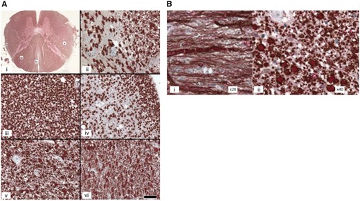 Spinal cord of a SPAST mutated patient. (A) Spinal cord of Patient FSP-625-011: alteration of the spinocerebellar and spinocortical tracts and posterior columns. Double labelling of myelin basic protein/neurofilaments (MBP/NF). (i) Transversal section of the spinal cord at the thoracic level. (ii–vi) Scale bar = 50 µm, MBP: brown/NF: red. (ii) Posterior spinocerebellar tract: loss of myelinated and unmyelinated fibres in the dorsal spinocerebellar tract. (iii) Fasciculus cuneiformis: sparing of the fasciculus cuneiformis. (iv) Fasciculus gracilis: loss of myelinated and unmyelinated fibres. (v) Cortico-spinal lateral tract at the thoracic level: numerous processes of small diameter among unusually large myelinated fibres, suggesting marked regeneration of the corticospinal tract. Arrows indicate clusters of small fibres. (vi) Lateral corticospinal tract at the level of the medulla oblungata: the number of small regenerating fibres appear to be as large in the medulla as at the thoracic level. (B) Pyramidal tract of the spinal cord. (i) Atypically large fibres with a sausage-like aspect and a poor myelin layer in longitudinal sections. (ii) Neurodegeneration and axon spheroids detected in transversal sections.