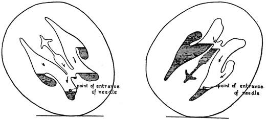 Diagram showing the positions of the head for optimal withdrawal of CSF from a single ventricular puncture. From Dandy (1918).