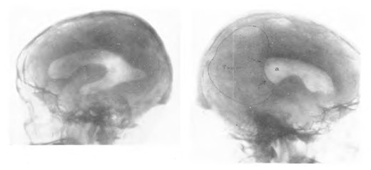 Ventriculogram showing a relatively unaffected right lateral ventricle (left) and a left lateral ventricle (right) in which the posterior horn has been compressed by a tumour. From Dandy (1920).