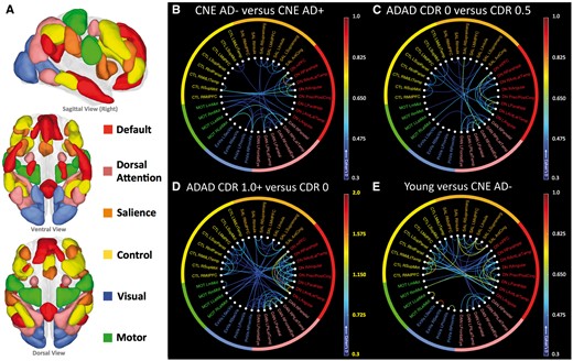 Nodal connectivity, grouped by network. Within- and between-network positive connections lost in preclinical Alzheimer’s disease, ADAD, and normal ageing are shown. (A) Cortical networks were separated into their constituent nodes prior to connectivity analysis. The size and anatomic locations of each node are shown in A above, with colours to indicate network membership for each node. Abbreviations and further anatomic detail can be found in Supplementary Fig. 1 and Supplementary Video 1. Extrastriate and primary visual networks are combined. (B) CNE AD+ participants showed lower connection strength as compared to CNE AD− especially within the default and dorsal attention networks. (C) ADAD mutation carriers at CDR 0.5 show degraded connectivity as compared to asymptomatic mutation carriers (CDR0), especially in the default and dorsal attention networks. (D) As a group, ADAD mutation carriers with dementia (CDR1+) show decreased connectivity across several networks, with the greatest change in the default and dorsal attention networks. As group level changes in this comparison were larger than in B, C and E, a broader scale range was used (indicated with yellow highlights). (E) Decreases in connectivity seen when comparing normal young participants with CNE AD− were broadly distributed across networks, with the greatest change in visual networks.
