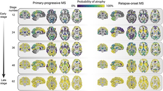 Regional atrophy and its sequence of progression in all grey matter regions plus brainstem in relapse-onset disease and primary progressive multiple sclerosis. The probability of atrophy in each region was calculated from the positional variance diagrams and colour coded, so that brighter colour corresponded to a higher probability of seeing atrophy in the corresponding event-based model stage. MS = multiple sclerosis.