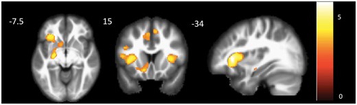 Results of whole brain voxel-based morphometry showing areas of significant atrophy in participants with nfvPPA (n = 9) relative to healthy controls (n = 60). The map was derived by conducting a two-group t-test, with age, sex, total grey matter volume, and scanner as covariates (P < 0.001, uncorrected). Colour bar represents t-values. One participant with nfvPPA could not be scanned because of contraindications.