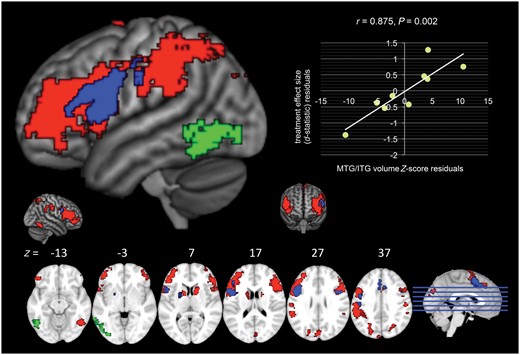 Volumetric analyses within the inferior frontal gyrus-seeded network. The healthy control inferior frontal gyrus-seeded network is depicted (red, green, and blue; Mandelli et al., 2016). Within that network, regions of significant atrophy in nfvPPA patients relative to healthy controls are indicated in blue (two-group t-test with age, sex, total gray matter volume, and scanner as covariates, P < 0.001, uncorrected) and the left middle/inferior temporal gyrus region of interest that significantly predicted treatment response (d-statistic, controlling for aphasia severity using Western Aphasia Battery AQ) is indicated in green.