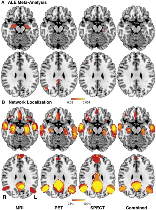 Network localization improves reproducibility of neuroimaging findings across modalities in Alzheimer’s disease. (A) Replication of prior ALE meta-analysis (Schroeter and Neumann, 2011) showing neuroimaging findings in Alzheimer’s disease patients based on structural (MRI), metabolic (PET), and perfusion (single-photon emission computed tomography, SPECT) imaging. No neuroimaging findings were reproducible across modalities (Combined). (B) In contrast, network localization of these same neuroimaging findings showed high reproducibility within and across modalities, with 100% of studies showing connectivity to the same set of brain regions. L = left; R = right.
