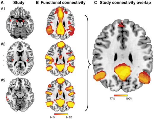 Network localization of neuroimaging findings method. (A) Spherical seeds (4 mm) were generated at each reported significant coordinate for each study, then added together to create a combined map of neuroimaging findings for each study. (B) Regions significantly connected to each study’s neuroimaging findings were calculated using a large (n = 1000) normative connectome (maps thresholded at t > 5 corresponding to voxel-wise FWE-corrected P < 0.05). (C) Network maps from each study were overlaid to identify functional connections common to the greatest number of studies.