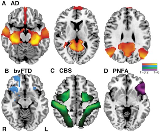 Network localization of neuroimaging findings is distinct for different neurodegenerative disorders. Specificity of network localization for each dementia syndrome versus all other syndromes (FWE-corrected P < 0.05) for Alzheimer’s disease (AD) (A), bvFTD (B), CBS (C), and PNFA (D). L = left; R = right.