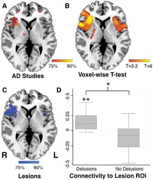 Common network localization for delusions in dementia and focal brain lesions. Neuroimaging findings from studies of Alzheimer’s disease patients with delusions were functionally connected to the right frontal cortex (A), a connectivity pattern that was specific compared to neuroimaging findings from studies of Alzheimer’s disease patients without delusion (B). Lesion locations causing delusions are also connected to the right frontal cortex (Darby et al., 2017), providing an a priori region of interest for the present study (C). Neuroimaging findings from studies of Alzheimer’s disease patients with delusions were significantly connected to this region of interest (Fischer’s r to z), and significantly more connected than neuroimaging findings in Alzheimer’s disease patients without delusions (D). *P < 0.005, **P < 0.001. L = left; R = right; ROI = region of interest.