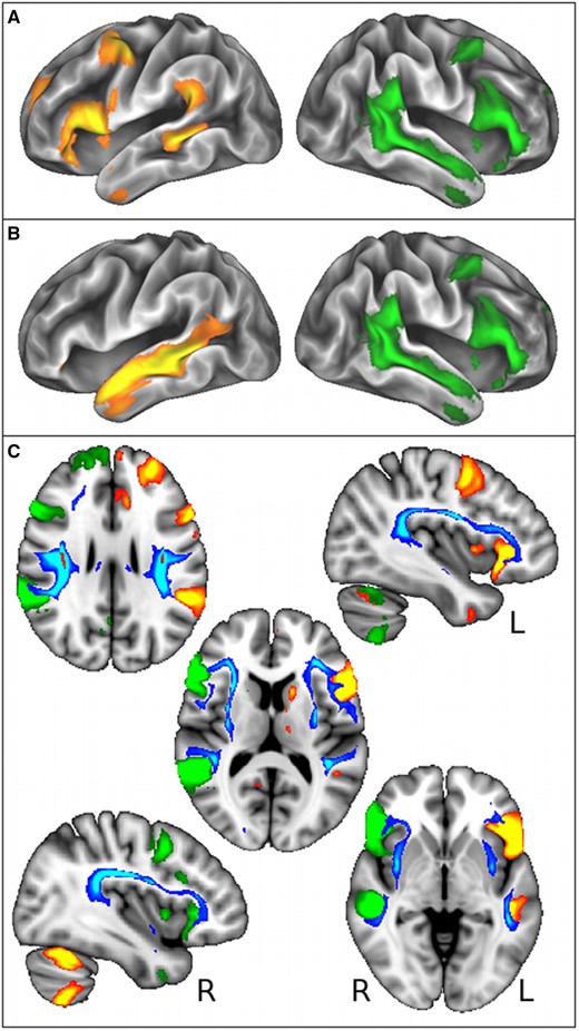 Language-related grey matter regions functionally involved with self-reported handedness are connected by white matter tracts associated with rs199512. (A and B) Left-handedness was most strongly associated with an increase in functional connectivity (temporal correlation) between right homologous language functional network (in green, encompassing Broca’s areas, the planum temporale and superior temporal sulcus, Z > 5), and a split of the left language functional network (in red-yellow, Broca’s areas and planum temporale shown in A, superior temporal sulcus shown in B, Z > 5). These language-related functional networks are overlaid on the cortical surface. (C) Voxelwise effects in white matter associated with rs199512 (in red, P < 3.6 × 10−7) were used as seeds for probabilistic tractography, which reconstructed the arcuate and superior longitudinal fasciculus (III) (in blue-light blue, thresholded for better visualization at 250 samples). Results are overlaid on the MNI T1-weighted template (axial views: z = 27, 12,−3 mm; sagittal views: x = −39, 39 mm). These white matter tracts clearly link the grey matter areas present in lateralized right- and left-sided language functional networks (in green and red-yellow, respectively, also shown in A and B).