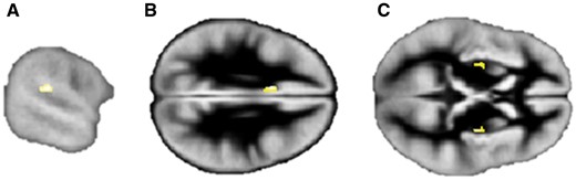 Grey matter differences between family members and control participants. Regions of decreased grey matter in the (A) left planum temporale/supramarginal gyrus, and increased grey matter in the (B) left cingulate and (C) bilateral putamen in family members relative to the control group. Images are displayed at P = 0.0001, uncorrected for multiple comparisons and overlayed onto the group specific grey matter template. See text for peak coordinates. Left hemisphere is on the top in axial views.