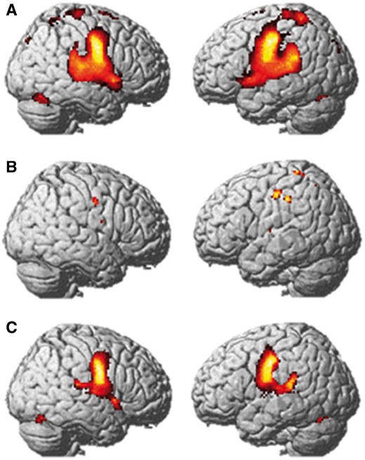 Functional MRI during speech. Average group activation in the control group (A) and family (B), and map of activation difference (Control > family, C) for the Speak versus Listen contrasts. Results are displayed at the FWE corrected 0.05 significance level (A and C), and at the uncorrected P < 0.001 significance level for the family (B) as no activation was detected with FWE correction. Results are projected onto the SPM8 rendered image.