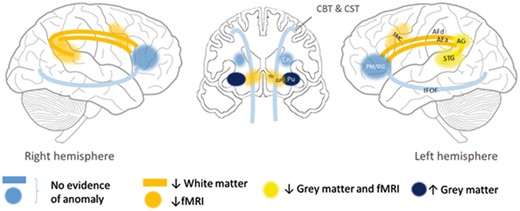 Proposed impaired bilateral dorsal network (yellow/orange) in this family, based on functional and structural imaging results. ↓ = reduced; ↑ = increased; AF = arcuate fasciculus (d = direct segment; a = anterior segment); AG = angular gyrus; CBT = corticobulbar tract; Cn = caudate nucleus; CST = corticospinal tract; GP = globus pallidus; IFOF = inferior fronto-occipital fasciculus; Pu = putamen; PM/IFG = premotor cortex/inferior frontal gyrus; SMC = sensori-motor cortex; STG = superior temporal gyrus; Th = thalamus.