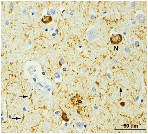 Tauopathy in the frontal lobe of a DIAN participant. N = neurofibrillary tangle; P = a neuritic plaque; arrows = neuropil threads. Phosphorylated tau (PHF1) immunohistochemistry. Scale bar = 50 mm.