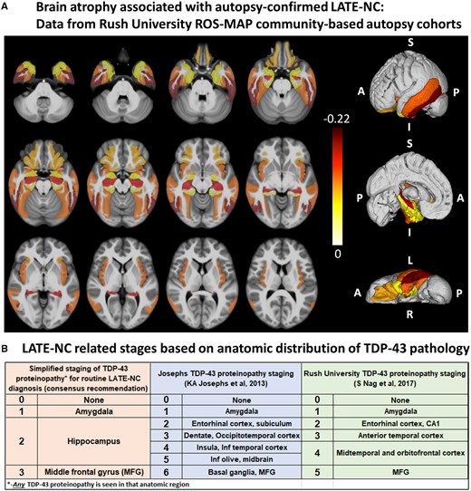 Brain regions that are affected in LATE. (A) Post-mortem MRI with autopsy confirmation allows discrimination of regions of brain atrophy associated with LATE-NC. These data indicate grey matter regions inside and outside of the medial temporal lobe with atrophy in cases with autopsy-confirmed LATE-NC from a community-based autopsy sample. The figure was prepared similarly to the methods used in Kotrotsou et al. (2015), with some modifications. Cerebral hemispheres from 539 participants of two cohort studies of ageing (Rush Memory and Aging Project and Religious Orders Study) were imaged with MRI ex vivo and also underwent detailed neuropathological characterization. The cortical and subcortical grey matter were segmented into 41 regions. Linear regression was used to investigate the association of regional volumes (normalized by height) with the score of LATE-NC at autopsy (scores: 0 = no TDP-43 inclusions, or inclusions in amygdala only; 1 = TDP-43 inclusions in amygdala as well as entorhinal cortex or hippocampus CA1, and neocortex; 2 = TDP-43 inclusions in amygdala, entorhinal cortex or hippocampus CA1, and neocortex, and hippocampal sclerosis pathology) controlling for amyloid plaques and neurofibrillary tangles, Lewy bodies, gross and microscopic infarcts, atherosclerosis, arteriolosclerosis, cerebral amyloid angiopathy, as well as age, sex, years of education, post-mortem interval to fixation and to imaging, and scanners. Unique colours have been assigned to different model estimates (units: mm2) for grey matter regions with significant negative correlation between their volumes and LATE pathology (P < 0.05, false discovery rate-corrected); darker colours indicate greater brain atrophy in that region. Results are overlaid on both hemispheres of the T1-weighted template of the IIT Human Brain Atlas (v.4.2). Lateral, medial and inferior to superior 3D views of the results are also shown. (B) Classification of LATE-NC according to anatomical region(s) affected by TDP-43 proteinopathy. The present working group recommended a simplified staging scheme for routine assessment of LATE-NC. This requires sampling and TDP-43 immunohistochemical staining of amygdala, hippocampus, and middle frontal gyrus. More detailed TDP-43 immunohistochemical staging schemes that are directly relevant to LATE-NC were previously published by Josephs et al. (2014a, 2016) and Nag et al. (2018). MFG = middle frontal gyrus.