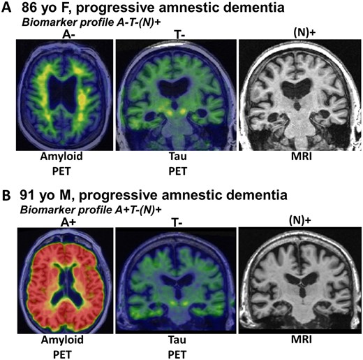 Biomarkers are currently not specific to LATE-NC. (A) Radiological scans from an 86-year-old female who suffered amnestic cognitive impairment compatible with ‘Probable Alzheimer’s disease’ diagnosis. However, the amyloid-β PET scan was negative, tau PET scan was also negative, and the MRI showed appreciable atrophy of the medial temporal lobes bilaterally. This combination is considered ‘A−T−N+’ and was diagnosed during life as ‘suspected non-Alzheimer’s pathology’ (SNAP). Autopsy within a year of the brain scans confirmed the presence of TDP-43 pathology and hippocampal sclerosis, which now is diagnosable as LATE-NC. (B) Another common biomarker combination, in the brain of a 91-year-old male with dementia. In this subject, the amyloid PET scan was positive, yet the tau PET scan was negative. The MRI again showed atrophy of the medial temporal lobes. The combination of pathologies—in this case presumed early ADNC and comorbid LATE-NC—is common, especially in the brains of subjects in advanced age.