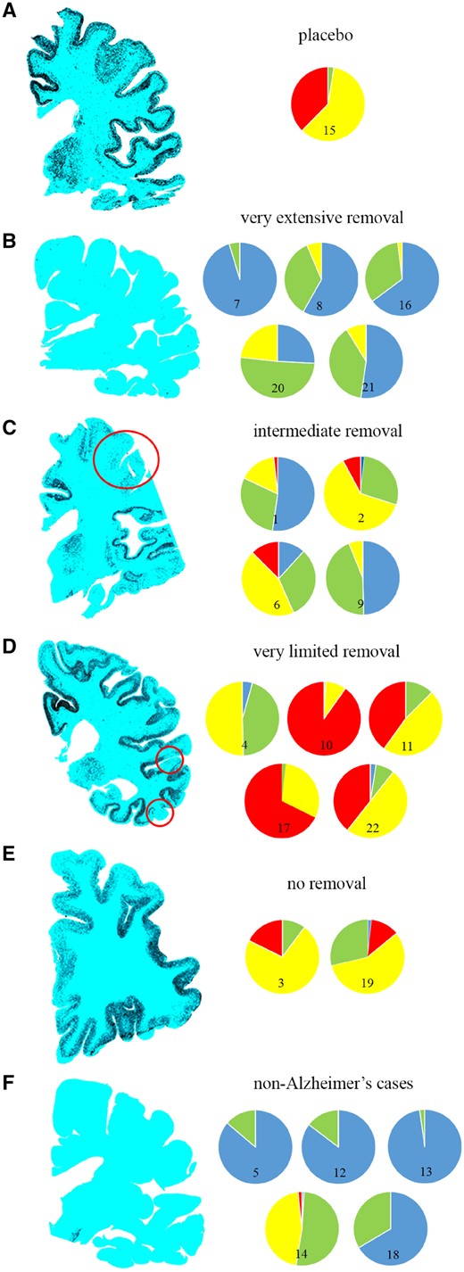 Scans of coronal histological sections of cerebral hemisphere from participants in the AN1792 trial immunolabelled to demonstrate amyloid-β (appearing black). The cases are grouped according to the extent of positive histological evidence of plaque removal on examination of all brain regions (Method 1). (A) Placebo with neuropathologically confirmed Alzheimer’s disease demonstrating a continuous band of plaques throughout the cerebral neocortex (Case 15). (B) Alzheimer’s subjects with nearly complete plaque removal (Cases 7, 8, 16, 20 and 21). (C) Alzheimer’s subjects with intermediate plaque removal (Cases 1, 2, 6 and 9). (D) Alzheimer’s subjects with limited plaque removal (Cases 4, 10, 11, 17 and 22). (E) Alzheimer’s subjects with no evidence of plaque removal (Cases 3 and 19). (F) Non-Alzheimer’s subjects (Cases 5, 12, 13, 14 and 18). Amyloid-β plaque density was scored throughout the neocortex of each hemisphere section using a CERAD-adapted method (Method 2) with the results colour-coded for illustrative purposes as: frequent plaques = red, moderate = yellow, sparse = green, none = blue, expressed as % of each category.
