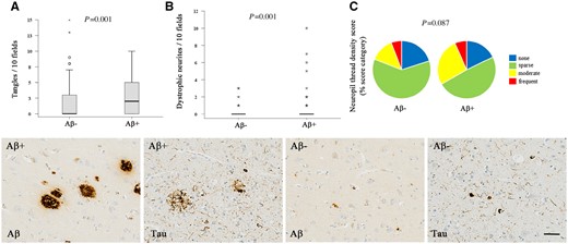 The effect of amyloid-β removal was quantified for each of the different histological features of intraneuronal tau accumulation (tangles, dystrophic neurite clusters and neuropil threads) by comparing cortical regions with amyloid-β plaques remaining (Aβ+) to regions with amyloid-β plaques removed (Aβ−). There were significantly fewer tangles and dystrophic neurite clusters in the regions where amyloid-β plaques had been removed in response to the amyloid-β immunotherapy; not significant for neuropil threads. Scale bar = 50 μm.