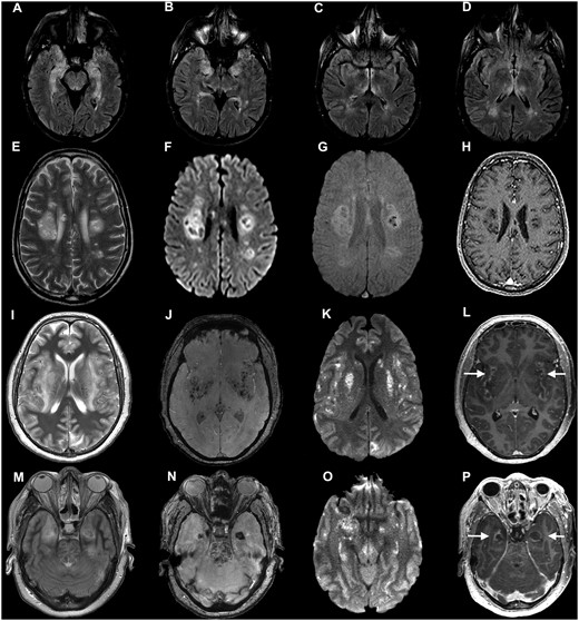 Imaging from Patients 12, 13 and 15 (COVID-19 autoimmune and haemorrhagic encephalitis). Axial MRI from three individuals with para-/post-infectious central syndromes. (A–D) Patient 12: axial fluid-attenuated inversion recovery (FLAIR) images show bilateral hyperintensity in the mesial temporal lobes (A and B), hypothalamus (C) temporal lobes and thalamus (D). (E–H) Patient 13: axial T2-weighted (E), diffusion weighted imaging (DWI) (F), susceptibility weighted imaging (SWI) (G) and post-contrast T1-weighted (H) images show multifocal clusters of lesions involving the deep white matter of both cerebral hemispheres, intralesional cyst-like areas of varied sizes, and some peripheral rims of restricted diffusion (F), some haemorrhagic changes (G), and T1 hypointense ‘black holes’ without contrast enhancement (H). (I–P) Patient 15: axial images at the level of the insula and basal ganglia (I–L) and at the level of the temporal lobes and upper pons (M–P). T2-weighted images (I and M), SWI images (J and N), DWI images (K and O) and contrast-enhanced images (L and P). There are extensive confluent areas of T2 hyperintensity (I and M), with haemorrhagic change on SWI imaging (J and N), restricted diffusion on DWI images (K and O) and peripheral contrast-enhancement (arrows in L and P) in the insular region, basal ganglia and left occipital lobe (I–L) as well as in the medial temporal lobes and upper pons (M–P).