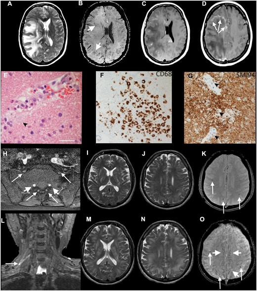 Axial MRI (A–D) and histopathology (E–G) from Patient 17, diagnosed with ADEM, and imaging (H–O) from Patient 16, with combined CNS and PNS disease. (A–G) Patient 17: axial T2-weighted (A), SWI (B), post-gadolinium (C and D) images show extensive confluent ‘tumefactive’ lesions involving the white matter of the right cerebral hemisphere, corpus callosum and corona radiata with mass effect, subfalcine herniation (A), clusters of prominent medullary veins (B, short arrows) and peripheral rim enhancement (D, arrows). (E) The white matter shows scattered small vessels with surrounding infiltrates of neutrophils and occasional foamy macrophages extending into the parenchyma (arrow). The endothelium is focally vacuolated but there is no evidence of vasculitis or fibrinoid vessel wall necrosis in any region. There were a few perivascular T cells in the white matter but the cortex appears normal (not shown). (F) CD68 stain confirms foci of foamy macrophages in the white matter, mainly surrounding small vessels. There was no significant microgliosis in the cortex (not shown). (G) Myelin basic protein stain (SMI94) shows areas with focal myelin debris in macrophages around vessels in the white matter (arrows) in keeping with early myelin breakdown. There is no evidence of axonal damage on neurofilament stain (not shown). Scale bars: E = 45 µm; F and G = 70 µm. (H–O) Patient 16: axial post-gadolinium fat-suppressed T1-weighted images (H) demonstrating pathologically enhancing extradural lumbosacral nerve roots (arrows). Note physiological enhancement of nerve root ganglia (short arrows). Coronal short tau inversion recovery (STIR) image (L) shows hyperintense signal abnormality of the upper trunk of the right brachial plexus (arrow). Initial axial T2 (I and J) and T2*-weighted images (K) show multifocal confluent T2 hyperintense lesions involving internal and external capsules, splenium of corpus callosum (I), and the juxtacortical and deep white matter (J), associated with microhaemorrhages (K, arrows). Follow-up T2-weighted images (M and N) show marked progression of the confluent T2 hyperintense lesions, which involve a large proportion of the juxtacortical and deep white matter, corpus callosum and internal and external capsules. The follow-up SWI image (O) demonstrates not only the previously seen microhaemorrhages (arrows) but also prominent medullary veins (short arrows).