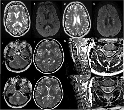Patients 19 and 20 (ADEM including spinal cord). Patient 19: axial T2 (A and C) and DWI (B and D) images show multifocal lesions involving corpus callosum and corona radiata. Patient 20: axial T2-weighted images of brain MRI and sagittal T2-weighted of the spinal cord acquired on admission (E–H) and after 26 days (I–L). Axial T2-weighted images show multifocal hyperintense lesions in the brainstem (E and I), basal ganglia and supratentorial white matter (F and J). The pontomedullary hyperintensities have become more confluent (I) since admission (E). After 26 days, the signal abnormalities in the basal ganglia and the supratentorial white matter (J) are grossly similar to the baseline MRI scan (F). Sagittal and axial T2-weighted images show diffuse high T2-weighted signal intrinsic to the spinal cord at baseline (G and H). After 26 days, the cord oedema has reduced, and the spinal cord lesions appear less confluent and more discrete (K and L).