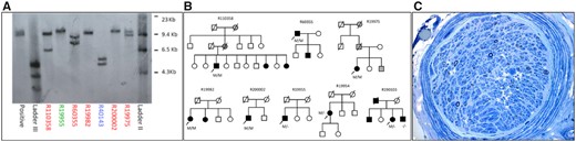 Southern blot results, pedigrees and sural nerve biopsy findings. (A) Southern blot results confirming RCF1 biallelic AAGGG expansions. The number of repeats for each allele are shown in parentheses. Patients R19975 (821, 1015), R19982 (1070, 1070), R110358 (292, 1192), R60355 (526, 821), and R200002 (1128, 1128). Patient R19955 was heterozygous for the AAGGG expansion (1325). Patient R40143 was positive for the repeat primed (AAAAG) PCR, which are non-pathogenic expansions. We considered pathogenic repeat expansions >250. (B) Pedigrees of families with biallelic pathogenic RCF1 expansions. Black filled symbols indicate affected individuals. Grey filled symbols indicate family members whose affected status is uncertain. Arrow indicates proband. Diagonal line indicates deceased individuals. M = allele with pathogenic RFC1 expansion; a dash indicates an allele without pathogenic RFC1 expansion. (C) Right sural nerve biopsy (Toluidine blue) from Patient R19977 showing a severe reduction in myelinated fibre density with only a few large myelinated fibres remaining in most fascicles. There were no inflammatory cell infiltrates. On the teased fibre preparation most fibres were of small diameter and thinly remyelinated. Ten per cent of fibres show evidence of previous demyelination/remyelination. Immunofluorescence stains for immunoglobulin, complement, fibrinogen and the Congo red stain for amyloid were negative. The findings are consistent with severe axonal loss consistent with a neuropathy or ganglionopathy.