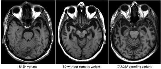 Axial T1-weighted MRI of the semantic dementia patient carrying somatic variant R42H, showing profound leftsided temporal atrophy 3 years after disease onset. Pathological examination 15 years after disease onset showed atrophy of both temporal poles. The middle image is from a patient without a somatic variant (4 years after onset) showing atrophy of both temporal lobes. Right: A patient with the germline (p.I383V) TARDBP variant, showing a similar atrophy pattern bilaterally (4 years after onset).