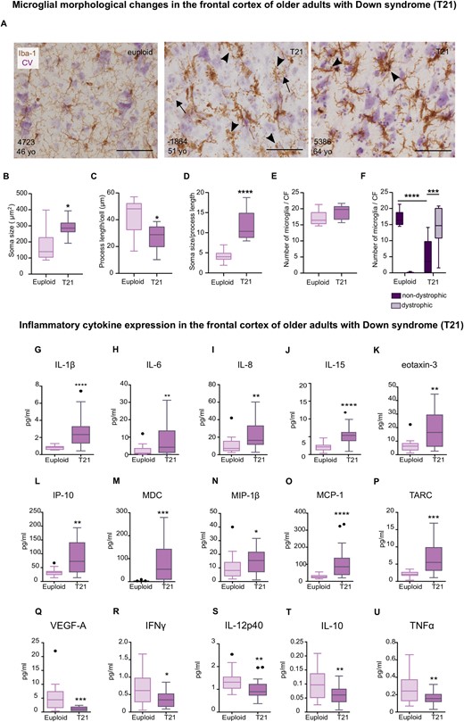 Dystrophic microglia and waning of neuroinflammation in older adults with Down syndrome. Top: (A) Representative photomicrographs of euploid and Down syndrome microglia (30–64 years old) as revealed by immunohistochemical assessment of Iba-1, cresyl violet (CV) was used as counterstain. (A) Dystrophic microglia from Down syndrome cases (middle and right micrographs) display spheroidal swellings and process beading (arrowheads), and fragmentation (arrows). (B) An increase in microglial soma size was noted in the Down syndrome cases, t(15) = 2.83, P = 0.01. (C) Down syndrome microglia displayed a decreased process length, t(15) = 2.60, P = 0.01. (D) The soma size-to-process length ratio was increased in microglia from adults with Down syndrome, t(15) = 5.40, P < 0.0001. (E) Total microglial cell number did not differ between Down syndrome and control groups, t(15) = 1.79, P = 0.09. (F) An increase of dystrophic microglia compared to non-dystrophic cells was observed in the Down syndrome group Accompanied by a decrease in non-dystrophic microglia compared to controls. Two-way ANOVA, effect of karyotype, F(1,30) = 0.42, P = 0.51, effect of morphology, F(1,30) = 6.22, P = 0.01, karyotype × morphology interaction, F (1,30) = 79.33 P < 0.0001 followed by Tukey’s post hoc test (T21 non-dystrophic versus T21 dystrophic, P = 0.0007; Euploid non-dystrophic versus T21 non-dystrophic, P < 0.0001). Euploid n = 10, T21 n = 8. Bottom: (G–U) Analysis of frontal cortex homogenates by multiplex protein electrochemiluminescent assays revealed an increase in inflammatory expression (pg/ml) in (G–P), along with a decrease of inflammatory mediators in adults with Down syndrome (39–68 years old) (Q–U). (G) U = 35, P < 0.0001; (H) U = 82, P = 0.01; (I) U = 72, P = 0.005; (J) t(37) = 4.73, P < 0.0001; (K) U = 70, P = 0.008; (L) t(34) = 3.48, P = 0.001; (M) U = 51.5, P = 0.0004; (N) U = 117, P = 0.04; (O) U = 34, P < 0.0001; (P) U = 57, P = 0.0005; (Q) U = 63.5, P = 0.0004; (R) t(36) = 2.59, P = 0.01; (S) U = 74, P = 0.001; (T) t(36) = 2.87, P < 0.006; (U) t(35) = 2.72, P = 0.009. (A–E, J, L, R, T and U) Two-tailed unpaired Student's t-test; (G–I, K, M–P and R) two-tailed Mann Whitney tests. Euploid n = 16, T21 n = 22. Data are displayed in box plots where the box represents the interquartile interval in which the upper and bottom ends of the box represent the third and the first quartile, respectively. The horizontal line in the box represents the median. The vertical lines or whiskers extending from the box represent the minimum and maximum values in the dataset. Full circles represent outliers according to Tukey’s rule. Scale bar = 50 μm. *P < 0.05, **P < 0.01, ***P < 0.001, ****P < 0.0001. CF = counting frame.
