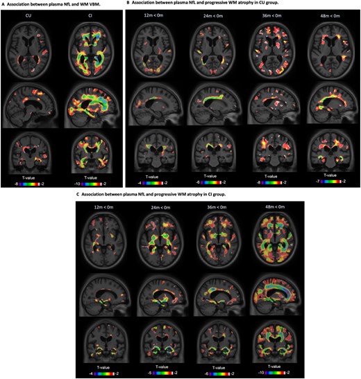 Plasma NfL and white matter volume. T-statistical parametric maps (T-maps) superimposed on average structural MRI show brain regions where higher NfL levels were associated with reduced white matter (WM) volume in cognitively unimpaired (CU) and cognitively impaired (CI) participants (A). T-maps also showed that, compared to baseline, there was a reduction of white matter volume associated with plasma NfL in cognitively unimpaired (B) and cognitively impaired groups (C) at each time point (D). T-values that were significant after random field theory correction for multiple comparisons are indicated in the text.