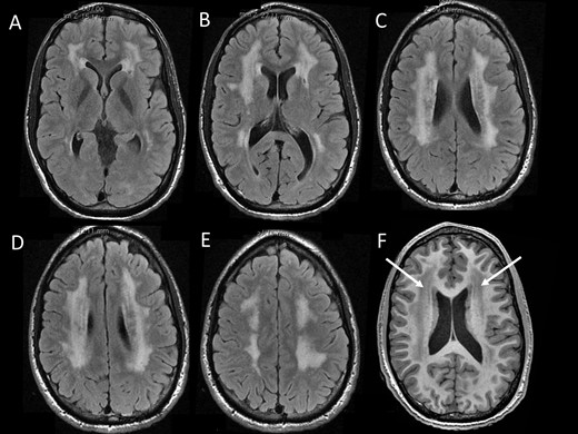 Brain MRI characteristics. MRI in Patient 1 at the age of 20 years showed diffuse periventricular white matter abnormalities with hyperintensenties on FLAIR sequences (A–E) and hypointensities (arrows) on T1-weighted sequences.