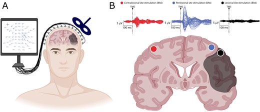 A combined TMS/EEG approach reveals local slow waves in perilesional cortex. Key findings of Sarasso et al. (2020). (A) Combination of a high-density EEG recording and neuronavigated TMS at different cortical sites (here illustrated for perilesional stimulation) allows mapping of EEG responses to cortical perturbations in awake patients with chronic brain injuries. (B) Slow waves in TMS-evoked EEG potentials of awake patients are specific for perilesional stimulation sites. Top: Butterfly plots of the TMS-evoked EEG potentials recorded at all 60 electrodes for three stimulation sites: contralesional (red), perilesional (blue) and targeting the lesion (black) in one representative patient. Bottom: Schematic of a cortico-subcortical brain lesion (shaded area) and different stimulation sites (coloured dots) shown on a coronal brain section. TMS = transcranial magnetic stimulation. Figure created with BioRender.com.