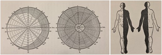 Contracted visual field and left hemianaesthesia. Extreme examples of reduced information processing in functional neurological disorder. From Janet (1907).