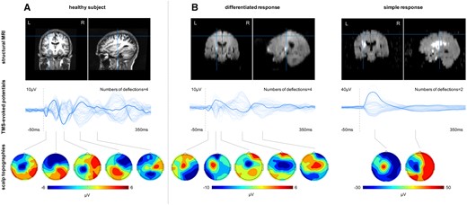 TMS-EEG responses to M1 stimulation in representative subjects. (A) Healthy subject. (B) Stroke patients. Top row: Lesion location. Middle row: Butterfly plot representing all 62 EEG electrodes (bold line: stimulation electrode/C3). Bottom row: Topographic plots of the TMS-evoked responses.