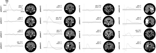 Differential TMS-EEG responses in the subgroup of patients with no evocable MEP. Individual TMS-EEG responses of the stimulated ipsilesional motor cortex for all patients (n = 16) without an MEP in the early subacute phase post-stroke. Grey bars indicate the 99% confidence interval derived by bootstrap statistics. Next to the TEP plots, the corresponding motor scores of the individual patients are shown. In addition, coronal slices of the individual diffusion-weighted MRIs are depicted, showing the acute ischaemic lesion. Please also note that bilateral hyperintensities at the temporal lobes results from susceptibility artefacts.