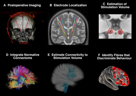 Identifying fibres discriminative of gambling behaviour. A supplementary analysis was undertaken to identify distinct patterns of connectivity between ‘cases’ and ‘non-cases’. (A) Subthalamic electrodes were identified on postoperative imaging. (B) Electrodes were localized in ICBM 2009b non-linear asymmetric space using the Lead-DBS toolbox. (C) Stimulation volumes were estimated for each participant based on individual stimulation parameters. (D) A normative connectome from the PPMI was integrated with the cohort. (E) Fibres from this connectome passing through each stimulation volume were isolated. (F) Measuring the behavioural variable (bet size in the virtual casino), each fibre was tested across the cohort between participants with a stimulation volume that encompassed the fibre (connected) and those where the fibre did not traverse the volume (unconnected). If there was a significant difference in bet size between participants with connected and unconnected VATs, then this fibre was identified as associated with betting behaviour. The top 20% of discriminative fibres were compared between ‘case’ and ‘non-case’ groups to identify distinct patterns of connectivity.