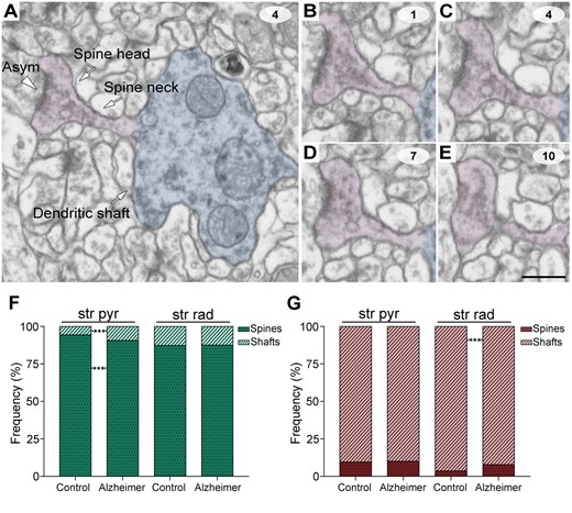 Postsynaptic target identification in serial electron microscopy images. (A) A crop from a FIB/SEM section to illustrate a dendritic shaft (blue) with a dendritic spine (purple) emerging from the shaft. An early-stage Alzheimer’s disease case (Case IF13, see Supplementary Table 1) is provided as an example. An axospinous asymmetric synapse (marked with an arrowhead) is established on the head of the spine. (B–E) Crops from FIB/SEM serial sections to illustrate an axospinous asymmetric synapse. The asymmetric synapse can be followed by navigating through the stack of images until it finishes (E); 60-nm thickness separation between images. (F and G) The percentage of axospinous and axodendritic synapses within the asymmetric synapses (F) and symmetric synapses (G) populations in the stratum pyramidale (str pyr) and radiatum (str rad) of CA1 in both control and Alzheimer’s disease cases. Alzheimer = Alzheimer’s disease; asym = asymmetric synapse. Statistical significance is represented by asterisks (***P < 0.001). Scale bar in E = 500 nm in A; 450 nm in B–E.