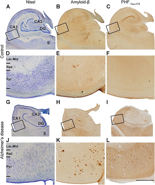 Micrographs of the human hippocampus containing the CA1 field. (A–C and G–I) Adjacent sections stained with Nissl (A and G), immunostained for anti-amyloid-β (Aβ) (B and H) and anti-PHF-Tau-AT8 (C and I), in a control case (AB2) (A–C) and Alzheimer’s disease (Case VK11) (G–I). Rectangles in A–C and G–I show regions at higher magnification in D–F and J–L, respectively. Note the clear cortical atrophy in the Alzheimer’s disease case. (H, I, K and L) Panels show the presence of immunostained amyloid-β-positive plaques and PHF-Tau-AT8-positive neurons in the CA1 field of the Alzheimer’s disease case. DG = dentate gyrus; Lac-Mol = stratum lacunosum-moleculare; Pyr = stratum pyramidale; Rad = stratum radiatum; S = subiculum. Scale bar in L = 5 mm in A–C and G–I; 1.25 mm in D–F and J–L.