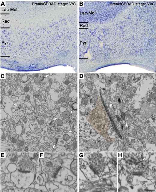 Nissl-stained sections and FIB/SEM images of the neuropil from Alzheimer’s disease cases showing different neuropathological stages. (A and B) Nissl-stained coronal sections of the human CA1 field of the hippocampus from Cases VK22 (A) and VK16 (B) (Braak/CERAD stage: V/C and VI/C, respectively; see Supplementary Table 1 for further details). Note in B that this case shows a dramatic neuronal loss (hippocampal sclerosis), in comparison to the other Alzheimer’s disease case shown in A. (C and D) FIB/SEM images of the neuropil of Cases VK22 (C) and VK16 (D). Some asymmetric synapses are marked with white arrowheads in C. Some bundles of thick electron-dense filaments inside neuronal processes are pointed out with white arrows in D. A dystrophic neurite has been pseudo-coloured in brown. (E–H) Asymmetric synapses shown at higher magnification from Cases VK22 (E and F) and VK16 (G). While the synapse observed in E–G are morphologically normal-looking, the synapse observed in H presents a presynaptic terminal virtually lacking synaptic vesicles and with intracellular thick electron-dense filaments (white arrow). These abnormal-looking synapses were only observed in Case VK16 (see also Supplementary Fig. 9). Lac-Mol = stratum lacunosum-moleculare; Pyr = stratum pyramidale; Rad = stratum radiatum. Scale bar in H = 350 µm in A and B; 762 nm in C and D; 354 nm in E–H.