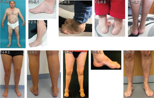 Phenotypic findings illustrated by photos of patients. Images of affected individuals showing foot deformities with pes cavus in Patients F2-II.1, F4-II.2, F5-II.1 and F6-II.1, pes equinovarus in Patient F3-II.5, surgically corrected pes equinovarus in Patient F3-II.7 and Achilles tendon lengthening in Patients F4-II.2 and F3-II.7. Lower leg atrophy can be clearly seen in Patient F5-II.2.