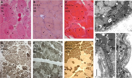 Muscle biopsy findings. (A–C) Haematoxylin and eosin stainingand (D–F) ATPase stainingof muscle biopsies in Patients F1-II.2, F2.II.1 and F5-II.1 are shown. (G–I) Electron microscopy of the muscle biopsy in Patient F1-II.2 is demonstrated. (A) Patient F1-II.2: tibialis anterior muscle (TA) showing severely increased fibre size variation, increase of internalized nuclei (asterisk), regenerative changes with whorled fibres (WF), fibre splitting (FS) and increased endomysial and perimysial fibrosis (Fib). (B) Patient F2-II.1: biceps brachii muscle (BB) showing mild increase of fibre size variation and of internalized nuclei (asterisk). (C) Patient F5-II.1: Gastrocnemius muscle (GCN) showing severely increased fibre size variation, increase of internalized nuclei (asterisk) and increased endomysial and perimysial fibrosis (Fib). (D) Patient F1-II.2: ATPase staining demonstrating grouping of atrophic fibres and fibre types indicating neurogenic changes. (E) Patient F2-II.1: ATPase staining demonstrating only mild fibre type grouping. (F) Patient F5-II.1: ATPase staining demonstrating fibre type grouping. (G) Electron microscopy shows osmiophilic paracrystalline inclusions (arrows) in several muscle fibre mitochondria (Scale bar = 1.5 µm). (H) No apparent focal disruptions of muscle fibre basal lamina (arrow) integrity was observed (Scale bar = 0.8 µm), but (I) invaginations of the sarcolemma (arrow) are seen (Scale bar = 1.5 µm).
