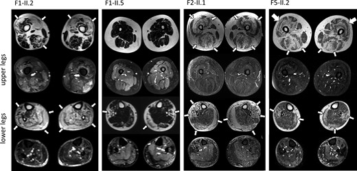 Muscle MRI findings. MRI of the legs demonstrates fatty degeneration (thin arrows) of muscle in Patients F1-II.2, F1-II.5, F2-II.1, and F5-II.2. There is predominant affection of the vastus and the medial head of the gastrocnemius as well as the peroneal muscles. A ‘sandwich sign’ (thick arrows) in the vastus lateralis muscles was present in Patient F5-II.2.