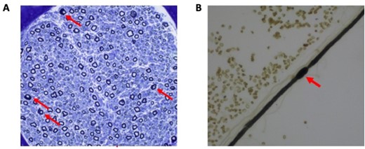 Nerve biopsy from a CADM3 patient. (A) A cross-section of sural nerve from a patient of Family 2 showing a reduced number of large myelinated fibres and very few groups of small regenerating fibres. Of interest, we overserved a number of abnormally myelinated fibres with thick folded myelin. A teased fibre from the same biopsy (B) shows such a focal myelin swelling or hypermyelination, a histological feature of demyelinating peripheral neuropathies.