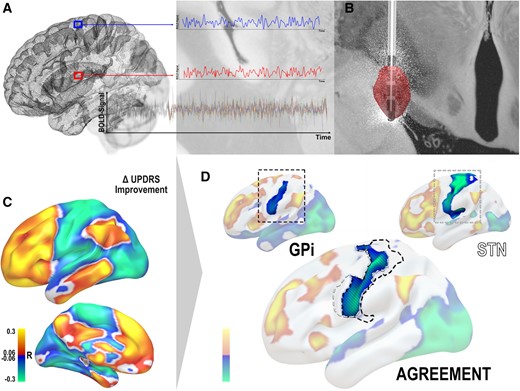 Methods overview. (A) The connectivity profile of each patient’s electric field was determined by using a normative functional connectome to estimate functional connectivity seeding from the electric field (B) to other areas of the brain. (C) This led to connectivity fingerprints for each patient based on which voxel-wise correlation maps with % improvement scores along the UPDRS were calculated (R-maps). Here, areas to which connectivity was associated with symptom relief are shown in warm colours and those associated with poor improvements are in cool colours. (D) Based on two R-maps, an agreement map was calculated by retaining areas that had the same sign on both maps (and multiplying their absolute values) and discarding areas in which signs on the two maps were conflicting. This is illustrated in a single example focusing on negative associations with the primary motor cortex.