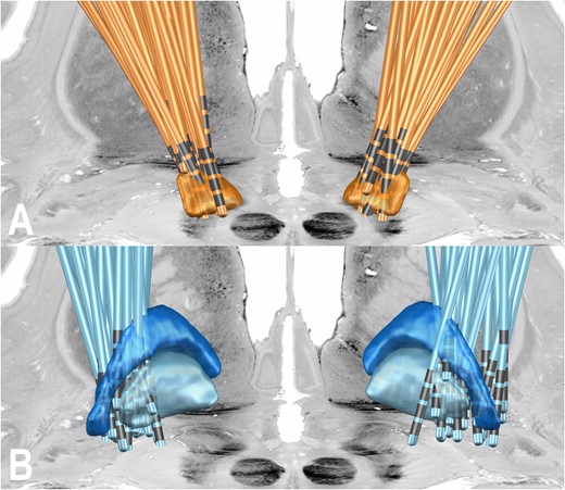 Electrode localizations of the two cohorts shown from posterior. (A) STN cohort described by Horn et al.5 (B) GPi cohort described by Odekerken et al.3 STN = orange; GPi = light blue; GPe = dark blue. The colours of the two cohorts match the colours in subsequent figures. In the background, transversal and coronal slices from the BigBrain atlas are shown.25