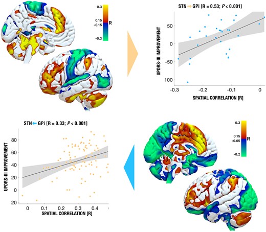 Connectivity maps associated with outcomes in bradykinesia and rigidity. Rigidity and bradykinesia were summarized due to high similarity when analysed independently. Only this map and pattern led to significant cross-predictions across STN and GPi targets. Instead, effects on tremor (not shown) were associated with a different connectivity pattern—also across targets and the cross-prediction did not yield significant effects.