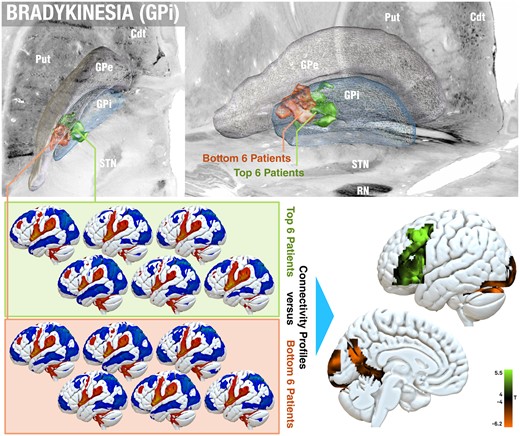 Effects of GPi-DBS on bradykinesia. Within the GPi cohort, it was noted that in some patients, bradykinetic symptoms worsened under DBS—as stated by previous reports.28,29 On a local level (top; showing a top and oblique view), the average electric fields of the top six improving and bottom six worsening patients were placed markedly differently, the latter in a more posterolateral location and closer to the GPe border. A paired t-test contrast between connectivity fingerprints of the same patients (bottom) revealed a positive association with left middle and inferior frontal gyrus (bradykinesia improvement) and negative association (worsening) with bilateral cerebellar and occipital regions, as well as the parieto-occipital sulcus (family-wise estimate corrected on cluster level at P < 0.05). Cdt = caudate nucleus; Put = putamen; RN = red nucleus.