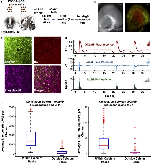Model of diffusely infiltrating glioma and experimental design. (A) PDGFA+/p53− glioma cells were injected into the subcortical white matter of Thy1-GCaMP6f mice. Coronal slices were obtained 25–30 days post-injection. A subset of mice was treated with a single dose of AZD8055 prior to injection, and slices from these mice were additionally bathed in AZD8055 during incubation. Two slices from each mouse underwent recording in artificial CSF and zero-Mg2+. (B) Orientation of slice on the array in preparation for optical mapping of Thy1-GCaMP fluorescence with histology. (C) Immunofluorescence micrographs demonstrating Thy1-GCaMP positive neurons and HA-positive glioma cells. mTOR signalling was present in both Thy1-GcaMP-positive neurons and HA-positive glioma cells, as indicated by the presence of phosphorylated S6 ribosomal protein. (D) Representative GCaMP fluorescence, LFP, and MUA from the same channel in a tumour-bearing slice. (E) Box plots showing temporal correlation between GCaMP fluorescence with LFP (n = 621, P < 0.01, Mann-Whitney U-test, two-tailed) and MUA (n = 621, P < 0.01, Mann-Whitney U-test, two-tailed). Scale bars = 400 μm (B), 50 μm (C).