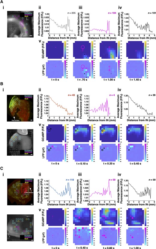 mTOR inhibition restores FS cell-mediated local inhibition during SLEs. (A) In control slices, the time-locked GCaMP signal around FS cell firing suggested intact local inhibition. Areas with increased GCaMP activity were located both proximal to and distal from areas with FS cell firing (ii). Four consecutive time points are shown (v) from Supplementary Video 3 (doi:10.6084/m9.figshare.19686390) during a representative SLE from a control slice. The representative slice shows that maximum GCaMP activity occur at a distance from the FS cells. Moreover, the FS cells appear to inhibit spread. (B) In untreated tumour-bearing slices, the time-locked GCaMP signals with the greatest amplitudes were proximal to electrodes with FS cell firing (ii). As distance from the electrodes with these FS cells increased, the time-locked GCaMP signal amplitude decreased. Four consecutive time points are shown (v) from Supplementary Video 4 (doi:10.6084/m9.figshare.19686387) during a representative SLE from an untreated tumour-bearing slice. The representative slice shows maximum GCaMP activity occurring in the electrodes with FS cell firing. (C) Treated tumour-bearing slices recapitulated the findings seen in controls, suggesting that mTOR inhibition restores the contribution of FS cells to local inhibition during SLEs (ii). Four consecutive time points are shown (v) from Supplementary Video 5 (doi:10.6084/m9.figshare.19686384) during a representative SLE from a treated tumour-bearing slice. The representative slice shows maximum GCaMP activity occurring at a distance from FS cell firing. Across all cohorts, areas of increased GCaMP activity occurred distal to FS cells engaged in local inhibition (iii) and proximal to FS cells recruited to excitatory activity (iv) (A–C). Control and treated tumour-bearing slices possessed a greater percentage of FS cells contributing to local inhibition (50.7% and 50%, respectively) compared to untreated tumour-bearing slices (9.3%). Representative histology (HA-positive glioma cells, red; Thy1-positive neurons, green) shown with pictures of slices placed on the array (i). Scale bars = 400 µm. Heat maps denote GCaMP (top) and LFP (bottom) amplitude. Radii of circles (magenta for FS cells contributing to local inhibition, black for FS cells recruited to excitatory activity) on heatmaps indicate the instantaneous firing rate of the FS cells in that electrode.