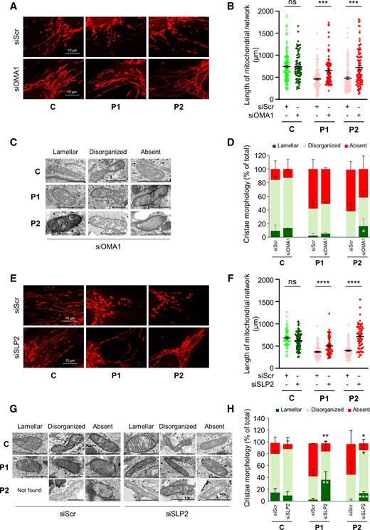 OMA1 or SLP2 depletion rescues mitochondrial network fragmentation and abnormal cristae morphology in CHCHD10S59L/+ fibroblasts. (A) Control (C) or patient (P1, P2) fibroblasts were transfected with scrambled siRNA (siScr), as a negative control, or OMA1 siRNA (siOMA1). Representative images of mitochondrial network from transfected fibroblasts. Mitochondria were stained with MitoTracker. Scale bar = 10 µm. (B) Quantification of mitochondrial network length in transfected fibroblasts. Randomly selected individual 30–40 cells per each transfection were analysed from three independent experiments. Values are mean ± SEM. (C) Representative images of mitochondrial morphology by electron microscopy, 72 h after transfection with siOMA1. Lamellar, disorganized or absent refer to mitochondrial cristae state. Scale bar = 1 µm. (D) Quantification of mitochondrial morphology observed in C. n = 3 independent experiments (44–132 mitochondria per experiment). Values are mean ± SD. (E) Control (C) or patient (P1, P2) fibroblasts were transfected with scrambled siRNA (siScr), as a negative control or SLP2 siRNA (siSLP2). Representative images of mitochondrial network from transfected fibroblasts. Mitochondria were stained with MitoTracker. Scale bar = 10 µm. (F) Quantification of mitochondrial network length in transfected fibroblasts. Randomly selected individual 30–40 cells per each transfection were analysed from three independent experiments. Values are mean ± SEM. (G) Representative images of mitochondrial morphology by electron microscopy, 72 h after transfection. Lamellar, disorganized or absent refer to mitochondrial cristae state. Not found corresponds to the absence of mitochondria with lamellar cristae in P2 cells after transfection with siScr. Scale bar = 1 µm. (H) Quantification of mitochondrial morphology observed in G. n = 3 independent experiments (49–161 mitochondria per experiment). Values are mean ± SD.