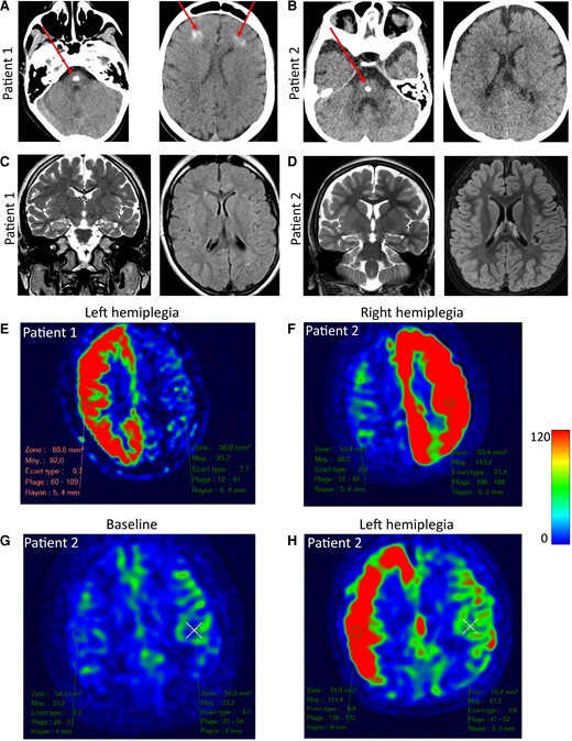 Neuroimaging of patients with hemiplegia. (A) Brain CT scan of Patient 1 (aged 6 years). A large calcification is observed in the brainstem in addition to bifrontal, subcortical calcifications in the white matter (red arrow). (B) Calcification observed in the brainstem of Patient 2 but no other brain region (red arrow). No cerebellar anomaly, abnormal gyration, corpus callosum anomaly or ventricular dilatation were noted in either patient. (C) Brain MRI in basal conditions of Patient 1 (aged 6 years, 6 months) show a moderate, isolated hyperintensity of the right hippocampus with no abnormal gyration or ventricular dilatation on axial FLAIR sequence. (D) Similar findings were observed in Patient 2. (E) Brain MRI during episodes of alternating hemiplegia in Patient 1. ASL sequence of Patient 1 aged 15 years during an episode of left hemiplegia. Note the unilateral increase of CBF. (F) ASL sequence of Patient 2 aged 4.5 years during an episode of right hemiplegia. (G) ASL sequence in Patient 2 in basal conditions and (H) ASL sequence in Patient 2 aged 1 year, 6/12 during a subsequent episode of left hemiplegia.
